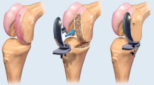 Knee joint replacement is a remarkable surgical intervention that breathes new life into worn-out or damaged knee joints